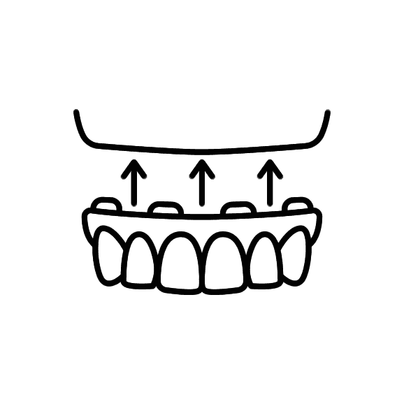 Hybrid Dentures
